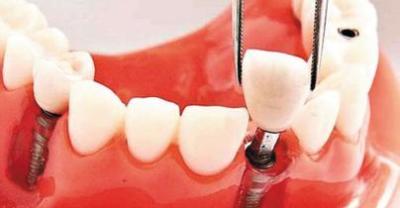 Comparison of dental implants and dentures
